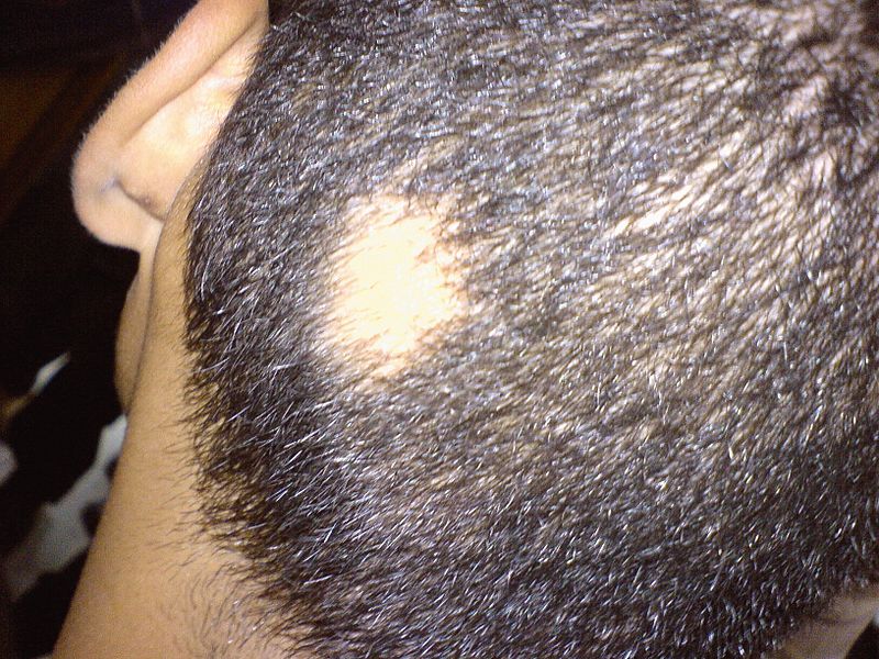 Acupuncture for Alopecia